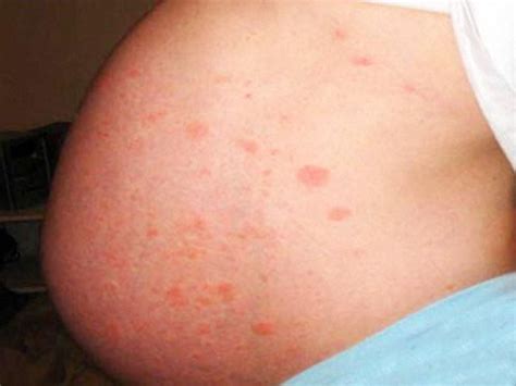 Management of herpes zoster (shingles) during pregnancy